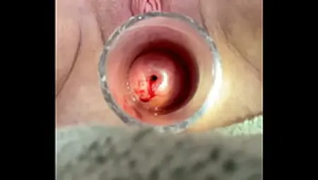 Removing Catheter From Deep In Uterus