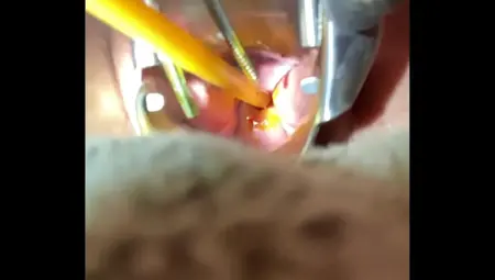 Inserting Foley Into Cervix