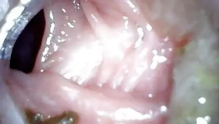 Anal Endoscope Part 2