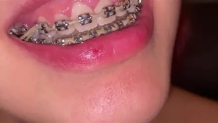SLUTS WITH BRACES SHOWS HER MOUTH INTO ASMR