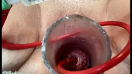 Inserting Catheter Into Cervix