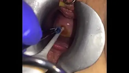 Cervix Extreme Gyno Play