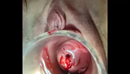 Crying As 18 Fr Catheter Penetrates Cervix